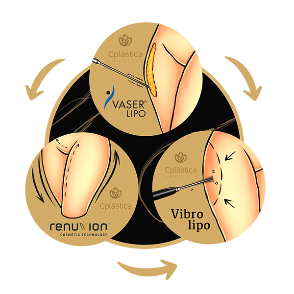 Technologies from Liposuction