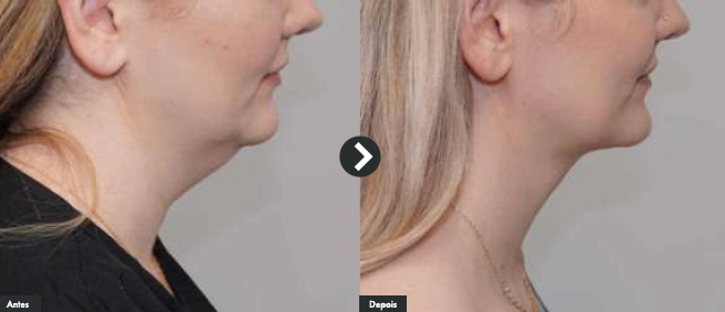 facetite
