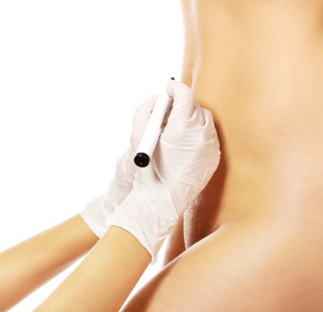 Lipoaspiração pubiana