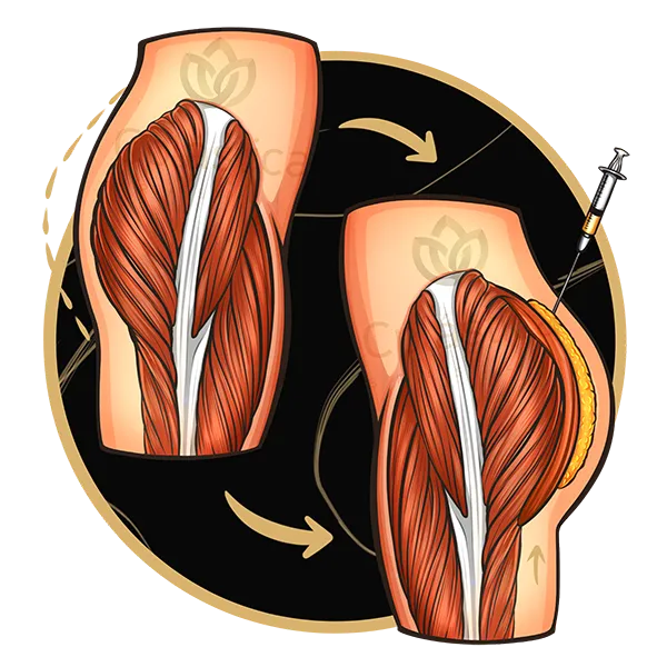 Enxerto de Gordura em Glúteo