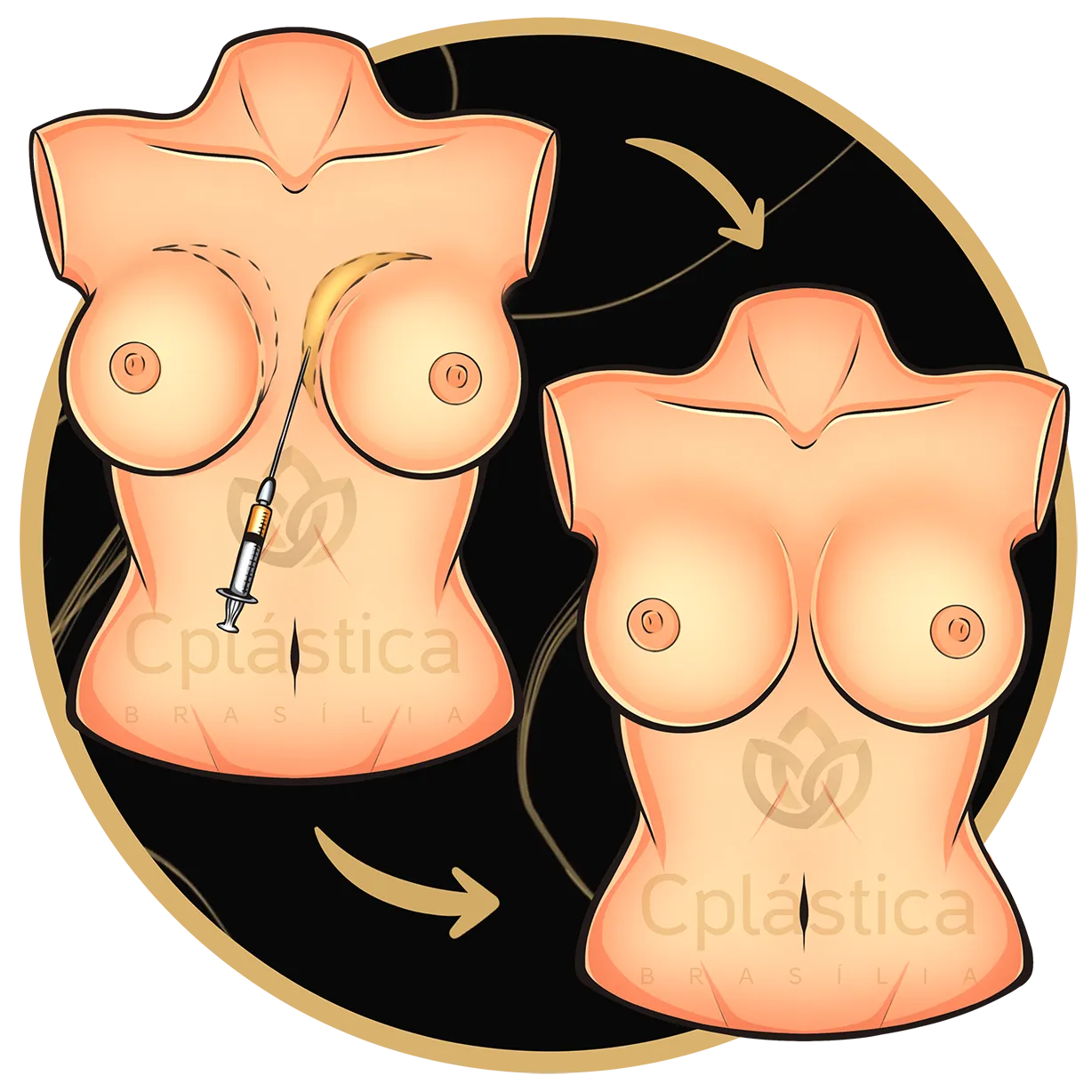 Cirurgia Híbrida ou Composta da mama