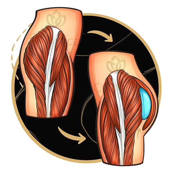 protese de gluteo